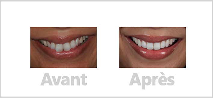 traitement Invisalign