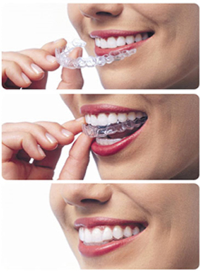 traitement Invisalign