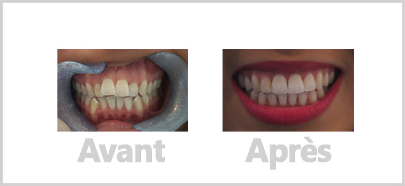 Traitement Invisalign