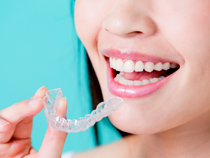 Orthodontie mineure Invisalign